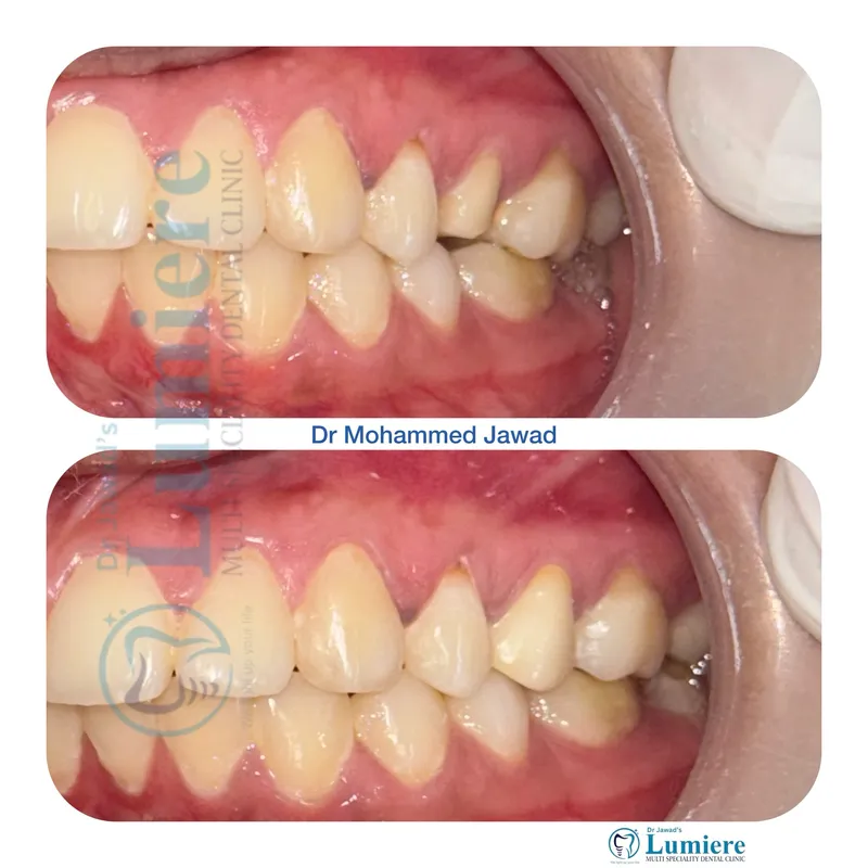 Teeth Deep Cleaning and Scaling Before and After
