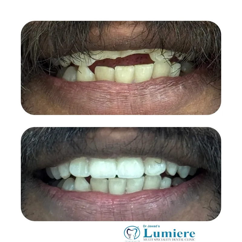 Anterior Smile Reconstruction Before and After