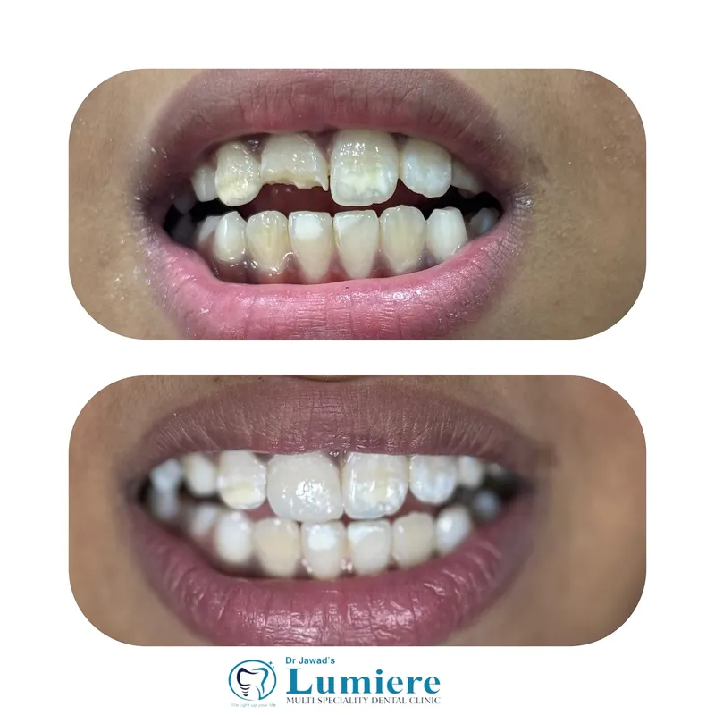 Fractured Tooth Repair Before and After