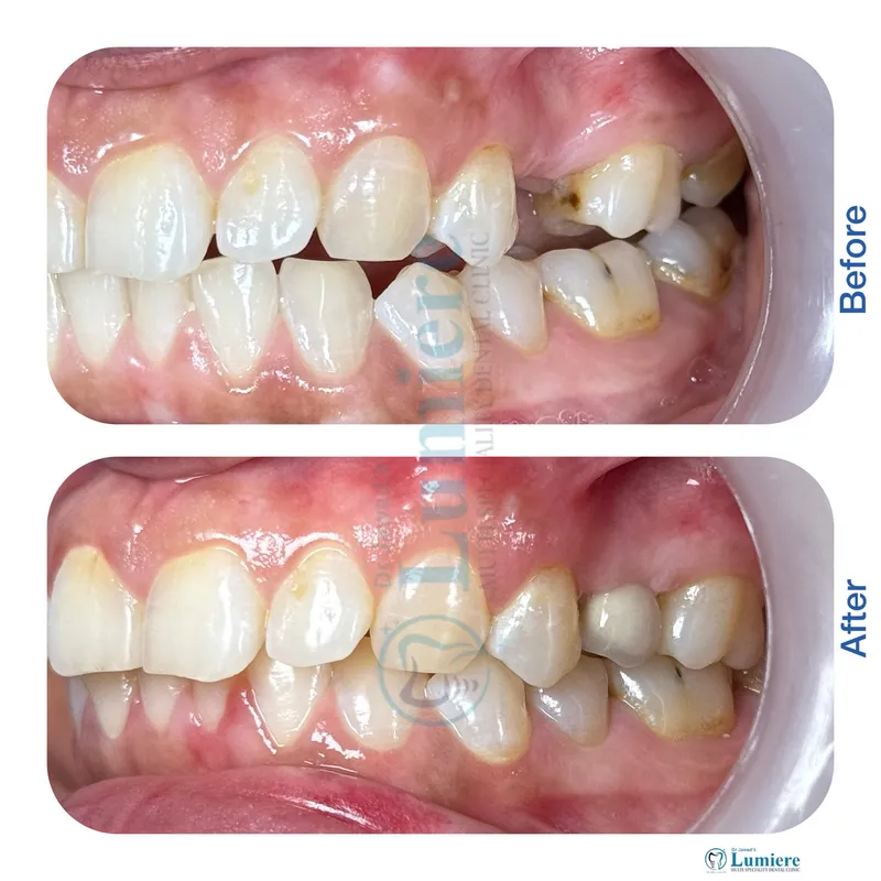 Premolar Dental Implant Before and After