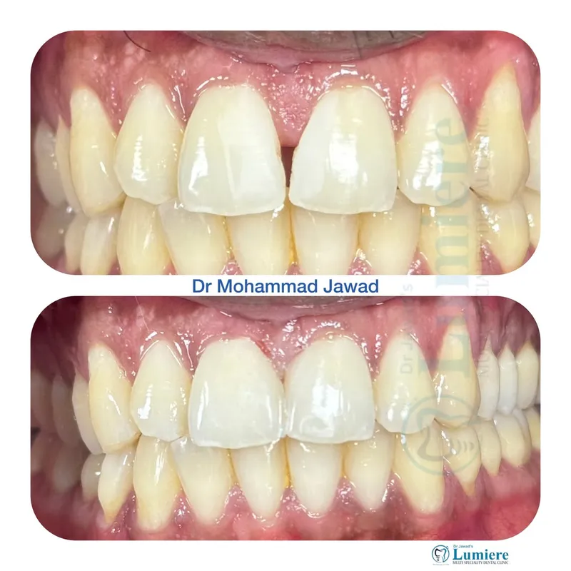 Midline Diastema Closure Before and After